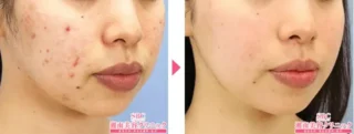 湘南美容クリニックケミカルピーリング症例写真