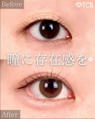 TCB式1dayクイックアイ