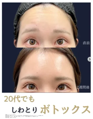 ボトックス