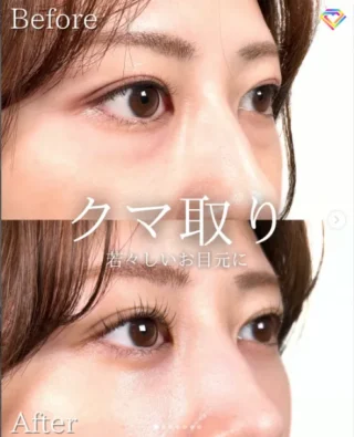 切らない⽬の下のクマ取り・たるみ取り＋目の下のヒアルロン酸注射