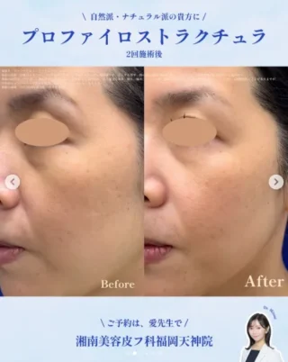 プロファイロストラクチュラ