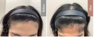 LHDV頭皮注入治療 + es women