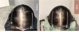 LHDV頭皮注入治療 + es women