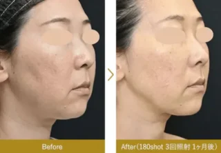 湘南美容クリニック新脂肪溶解リニアHIFU症例写真