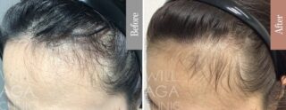 LHDV頭皮注入治療 + es women  