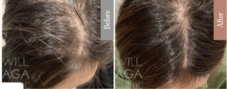 LHDV頭皮注入治療 + es women