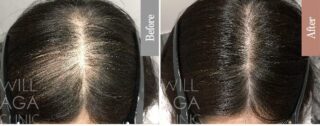 LHDV頭皮注入治療 + es women