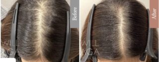 es women + LHDV頭皮注入治療 + リッチディオーラム