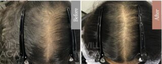 LHDV頭皮注入治療 + es women