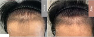 es women + LHDV頭皮注入治療