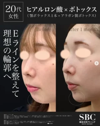 ヒアルロン酸×ボトックス
