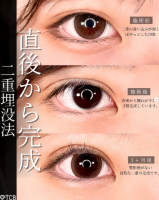 二重埋没+まぶたの脂肪取り