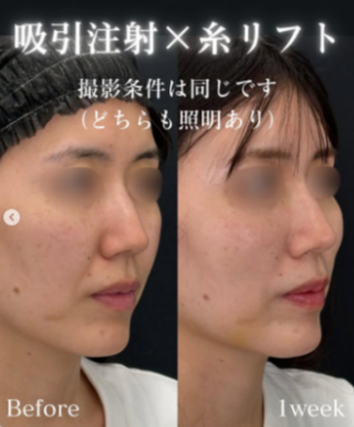 小顔用脂肪吸引注射