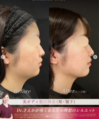 美ボディ脂肪吸引