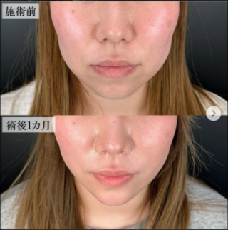 TCB式小顔脂肪吸引