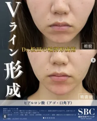 ヒアルロン酸(アゴ・口角下)