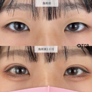 二重埋没法