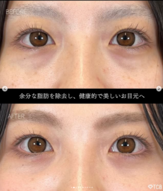 クマ取り治療
