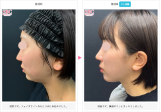 小顔用脂肪吸引注射
