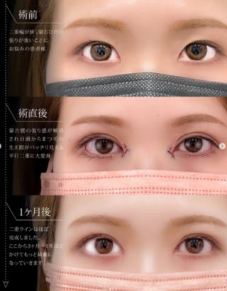 目頭切開+二重埋没法