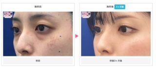 若返り / 目の下の切らないクマ・たるみ（ふくらみ）取り 他
