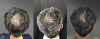 AGA治療