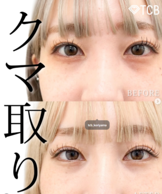 皮膚を切らない⽬の下のクマ取り・たるみ取り