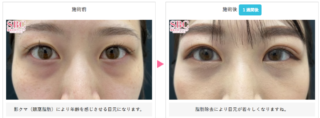 目の下の切らないクマ・たるみ(ふくらみ)取り