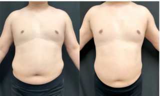 医療痩身(メディカルダイエット)