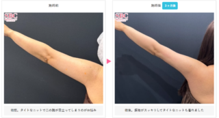 美ボディ脂肪吸引(二の腕 + 肩)