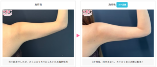 美ボディ脂肪吸引(二の腕)