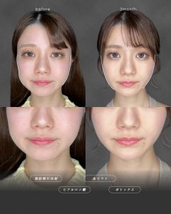 顔の脂肪吸引