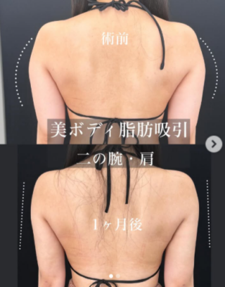美ボディ脂肪吸引(二の腕+肩)