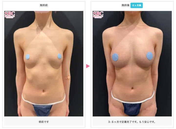 湘南美容クリニック脂肪注入豊胸症例写真