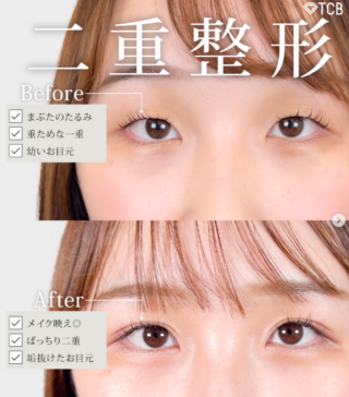 TCB式1dayクイックアイ