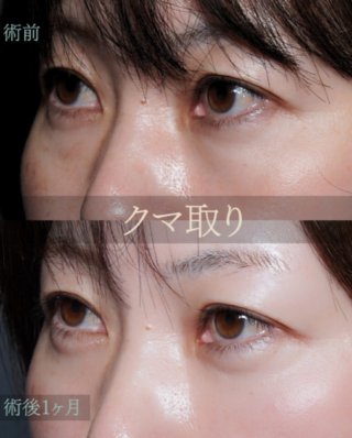 皮膚を切らない目の下のクマ取り・たるみ(ふくらみ)取り