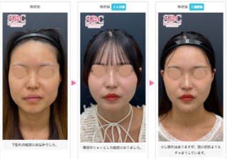 小顔用脂肪吸引注射
