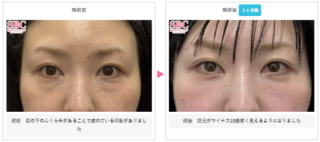 目の下の切らないクマ・たるみ(ふくらみ)取り + ナチュラル脂肪注射ナノリッチ