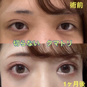 切らないクマ取り（経結膜脱脂法）