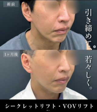 糸リフト（シークレットリフト・VOV（ボブ）リフト）