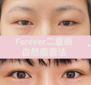 フォーエバー二重術