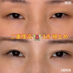 二重埋没　3点スクエア