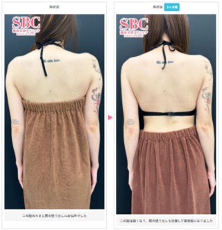 根こそぎVASER脂肪吸引
