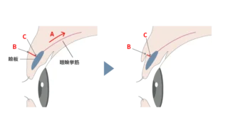 J CLINIC二重整形画像