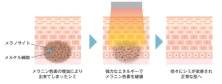 テラクリニック　Qスイッチルビーレーザー