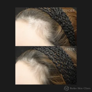【薄毛治療】CUREjet (MPF)＋Pluryal Hair Densityセット
