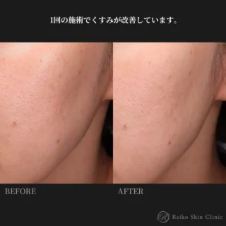 ミラノリピール