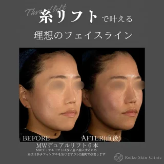 スレッドリフト（MWデュアルリフト 6本）